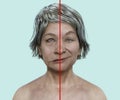 Facial palsy in a woman, 3D illustration highlighting the asymmetry and drooping of the facial muscles on one side of the face