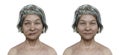 Facial palsy in a woman and the same healthy person, 3D illustration showing the asymmetry and drooping of the facial muscles on