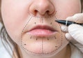 Facial plastic surgery. Hand is drawing lines with marker Royalty Free Stock Photo