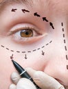 Facial plastic surgery. Hand is drawing lines with marker around eye Royalty Free Stock Photo