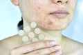 Facial skin problem with acne patch, Close up woman face with whitehead pimples and acne absorbing pad Royalty Free Stock Photo
