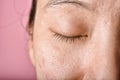 Facial skin problem, Aging problem in adult, wrinkle, acne scar, large pore and dark spot
