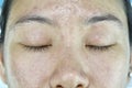 Facial skin problem, Aging problem in adult, wrinkle, acne scar