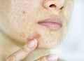 Facial skin problem, Close up woman face with whitehead pimples and acne patch