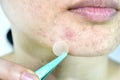 Facial skin problem, Close up woman scar face with whitehead pimples and acne patch.