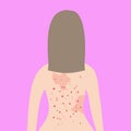 Fair hair woman. Acne on female back. Allergy treatment, skin problems concept.