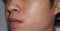 Fair skin with wide pores in oily face of Asian, Myanmar or Korean man Royalty Free Stock Photo