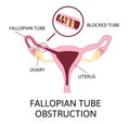 Fallopian tube obstruction or Blocked fallopian tubes