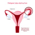 Fallopian tube obstruction. Cross section of Uterus. Close-up of Blocked fallopian tube