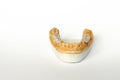 False teeth. bridge-ceramic-metal prostheses. Ceramic teeth dentures Royalty Free Stock Photo