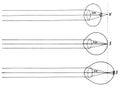 Farsightedness, normal and nearsightedness top to bottom