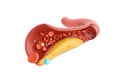 Fat and cholesterol in blood vessel Royalty Free Stock Photo