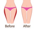 Fat and slim girls` hips. Before and after.