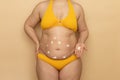 Fat woman in yellow swimsuit apply spot white body cream on thick sagging stomach, beige background. Slimming, fighting