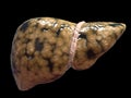 Fatty liver Royalty Free Stock Photo