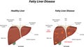 Fatty Liver Disease Royalty Free Stock Photo