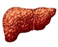 Fatty Liver Disease