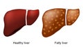 fatty liver disease. Healthy liver and hepatic steatosis