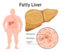Fatty liver disease, NAFLD. Extra fat in the liver. Overweight person Royalty Free Stock Photo