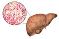 Fatty liver, liver steatosis Royalty Free Stock Photo