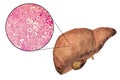 Fatty liver, liver steatosis Royalty Free Stock Photo