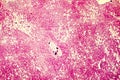 Light micrograph of a fatty liver Royalty Free Stock Photo