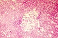 Light micrograph of a fatty liver Royalty Free Stock Photo