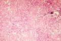 Light micrograph of a fatty liver Royalty Free Stock Photo