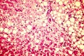 Light micrograph of a fatty liver Royalty Free Stock Photo