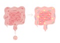 Fecal microbiota transplant from healthy in unhealthy intestine, FMT. Improvement intestinal microflora and