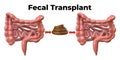 Fecal microbiota transplantation is a procedure in which a donor`s feces are placed in the bowel of the patient with intestinal