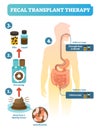 Fecal transplant therapy, procedure steps diagram, vector illustration. Renewing human digestive microflora.