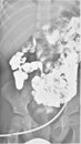 Feeding gtube contrast control xray exam gastrointestine