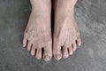 Feet of Asian elder woman. Concept of foot and toes health, and thin skin