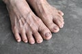 Feet of Asian elder woman. Concept of foot and toes health, and thin skin