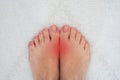 Feet disease Rheumatism and gout. Painful gout inflammation on big toe joint with red spots