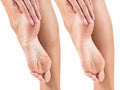 Feet with dry skin before and after treatment.
