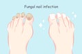 Feet with fungal nail infection Royalty Free Stock Photo