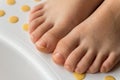 Feet with fungal toe nail infection. Close-up Royalty Free Stock Photo