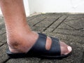 The feet of man with diabetes, dull and swollen. Due to the toxicity of diabetes