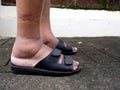 The feet of man with diabetes, dull and swollen. Due to the toxicity of diabetes Royalty Free Stock Photo