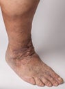 Feet old woman patient with varices on a white background