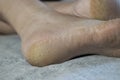 Feet of a patient with diabetes. Diabetic foot. Hyperkeratosis and cracks in the skin of the foot. Close-up