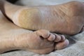 Feet of a patient with diabetes. Diabetic foot. Hyperkeratosis and cracks in the skin of the foot. Close-up Royalty Free Stock Photo