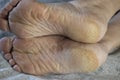 Feet of a patient with diabetes. Diabetic foot. Hyperkeratosis and cracks in the skin of the foot. Close-up Royalty Free Stock Photo