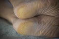 Feet of a patient with diabetes. Diabetic foot. Hyperkeratosis and cracks in the skin of the foot. Close-up Royalty Free Stock Photo