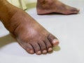 The feet of people with diabetes, dull and swollen.