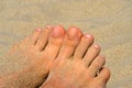 Feet and sand, inflamed skin near the nails, selective focus