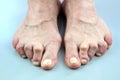 Feet Of Woman Deformed From Rheumatoid Arthritis