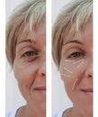 Female adult wrinkles removal contrast lift filler patient difference before and after procedures, arrow Royalty Free Stock Photo